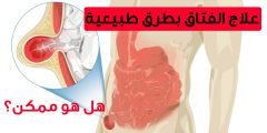 علامات الفتاق عند النساء وعلاجه مجرب