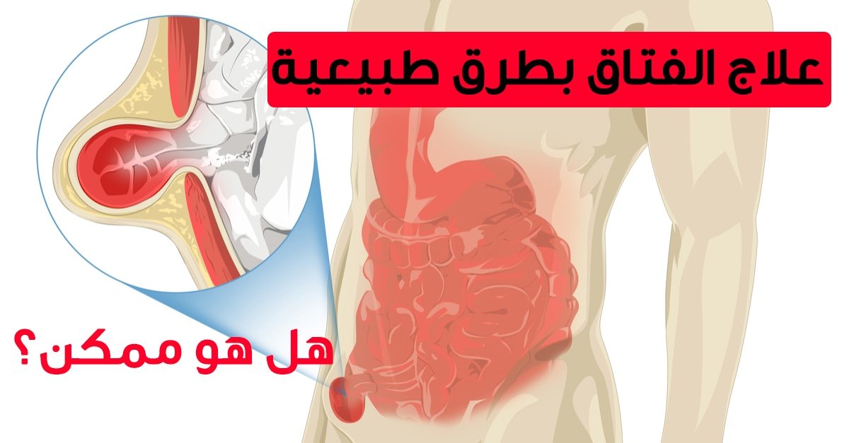 علامات الفتاق عند النساء وعلاجه مجرب