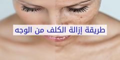 كيفية علاج الكلف والتصبغات وأسبابه .. خلطات علاج الكلف وتصبغات الوجه مجربة