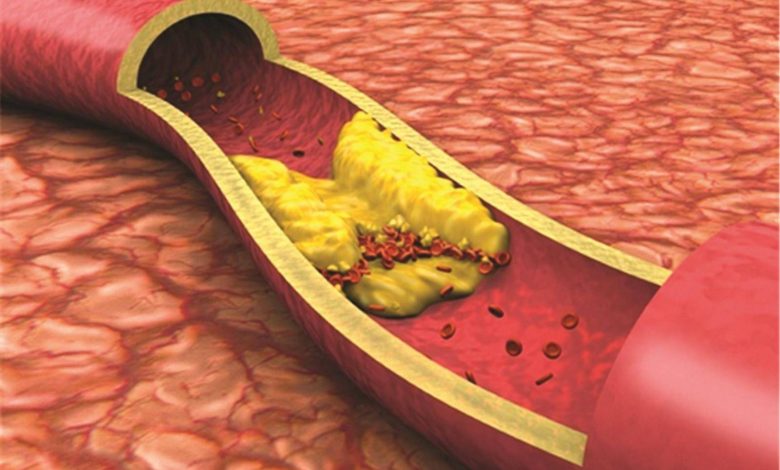 ارتفاع الدهون الثلاثية وطرق التحكم بها
