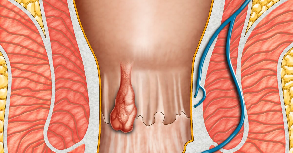 علاج البواسير وأعراضه وأسبابه