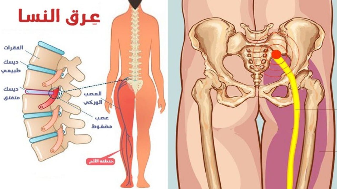 علاج مرض عرق النسا وأسبابه وأعراضه